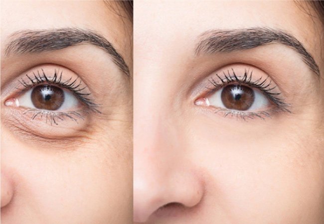 Best Eyelid Treatment in Gurgaon